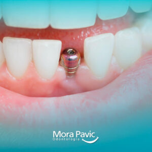 Diagnóstico de Implantes + Radiografías Incluidas